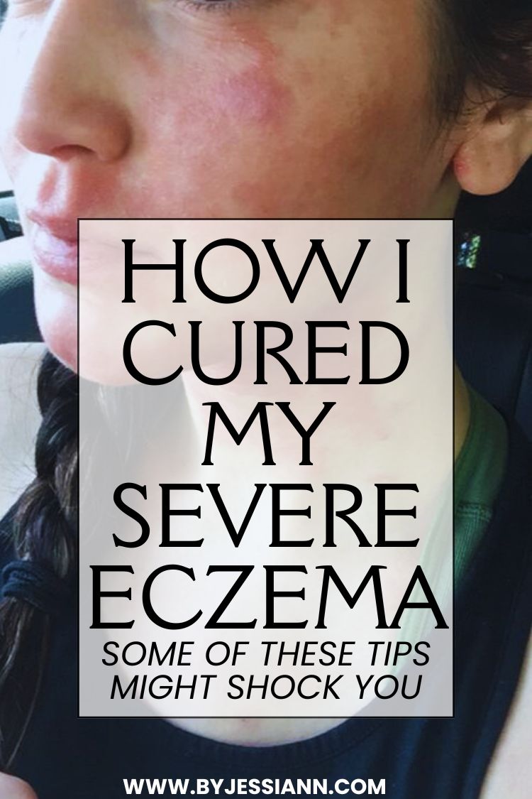 HOW I CURED MY ECZEMA